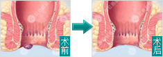 痔疮手术前后对比